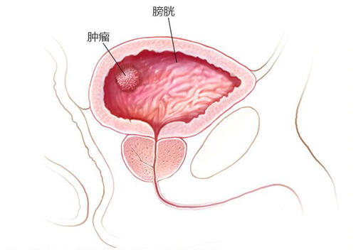 杭州御和堂中医：膀胱癌最常见的症状